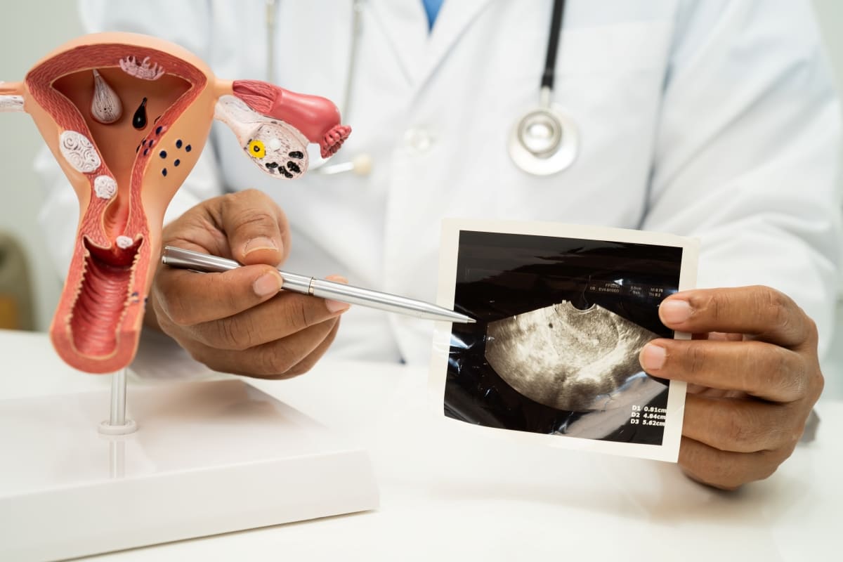 PCOS